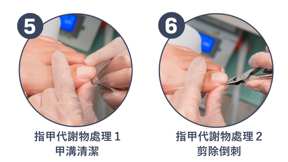 服務流程五:趾甲代謝物處理-甲溝清潔。服務流程六:剪除倒刺