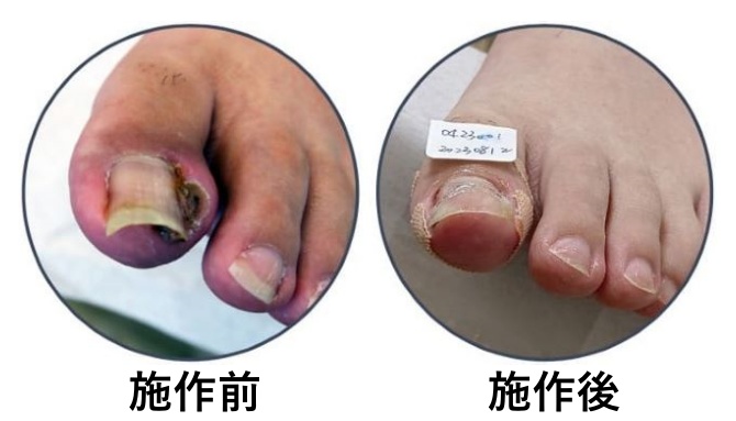 反覆甲溝炎導致產生肉芽,經由阿瘦嵌甲調整後,捲曲的指甲逐漸回到健康的角度