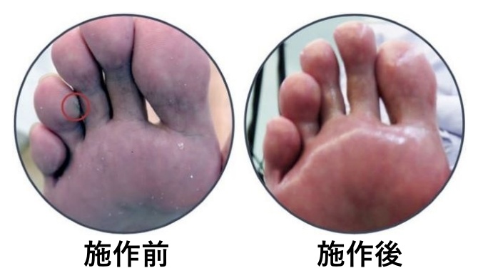 雞眼:健甲師用溫和的方式將雞眼磨除掉