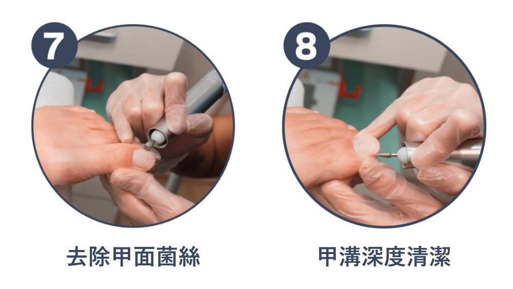 服務流程七:去除甲面菌絲。服務流程八:甲溝深度清潔