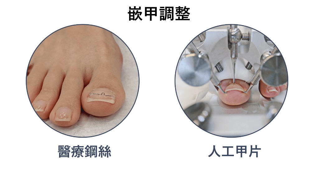 阿瘦獨家嵌甲調整:醫療鋼絲和人工甲片,幫助將卷曲的指甲調整到比較健康的角度