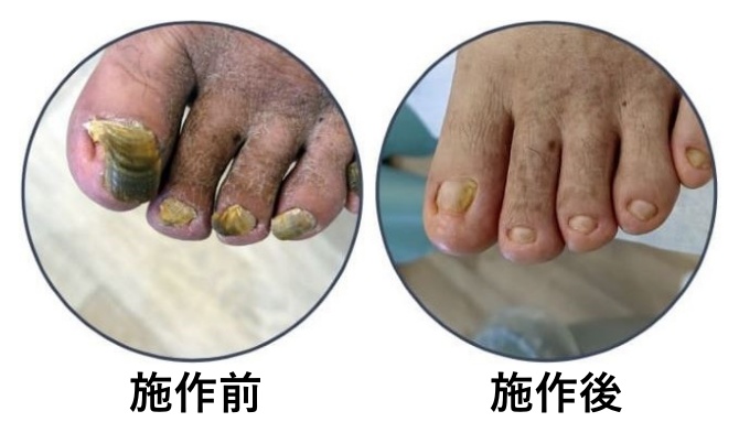 灰指甲經過健甲師使用消毒磨頭工具細心地位顧客處理受到感染的灰指甲區域