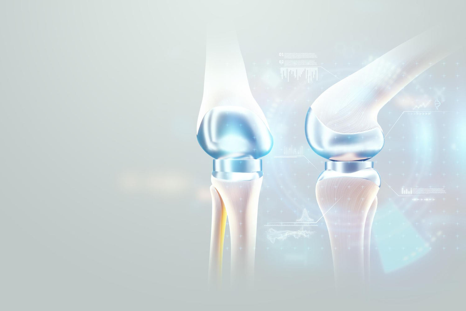 Hip implant Medical poster, image of the bones of the knee