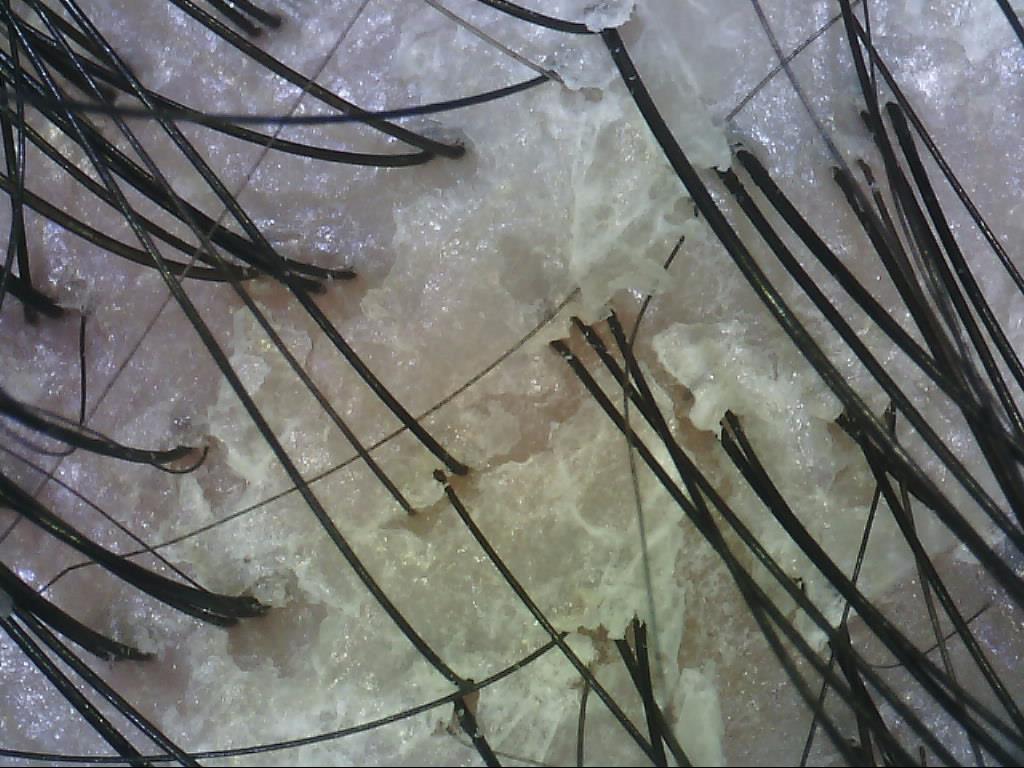 頭皮 脂 漏 性 画像 炎 皮膚