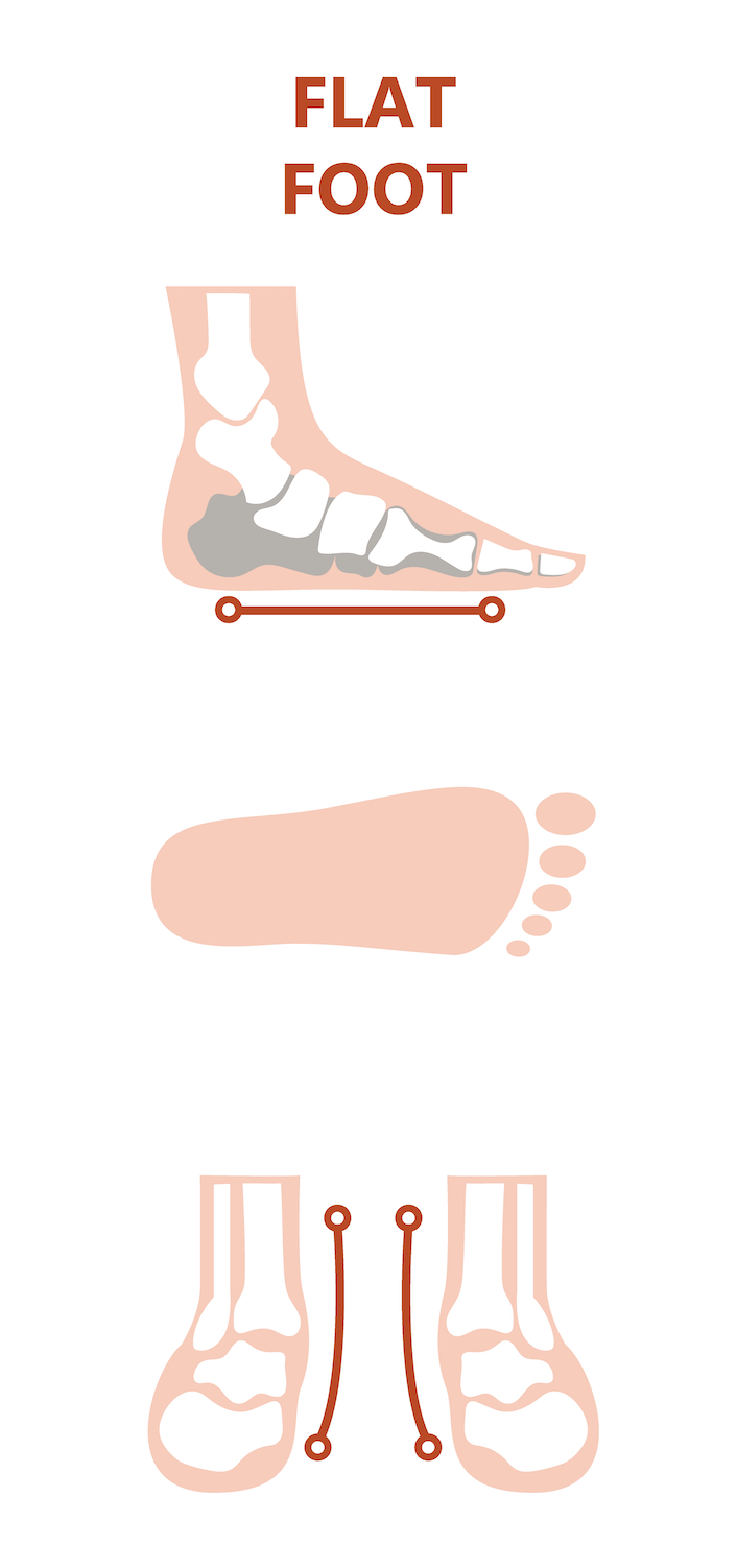 如果孩子在 3 歲後走路啪啪響、像鴨子走路，站久痠痛容易累，單腳跳或跑步時容易跌倒，就要注意是不是真的有扁平足，可能要把握足弓穩定前的 3-10 歲加以矯正。