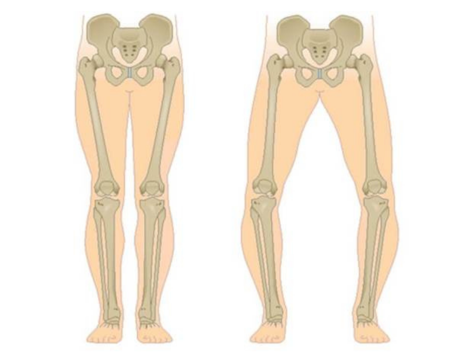 孩子到 5、6 歲以上還是 O 型腿、X 型腿，可能要尋求專業建議，預防孩子長大後的結構問題
