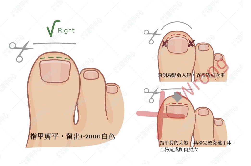 不要與人共用指甲剪或指甲銼，確保正確、仔細地剪指甲。