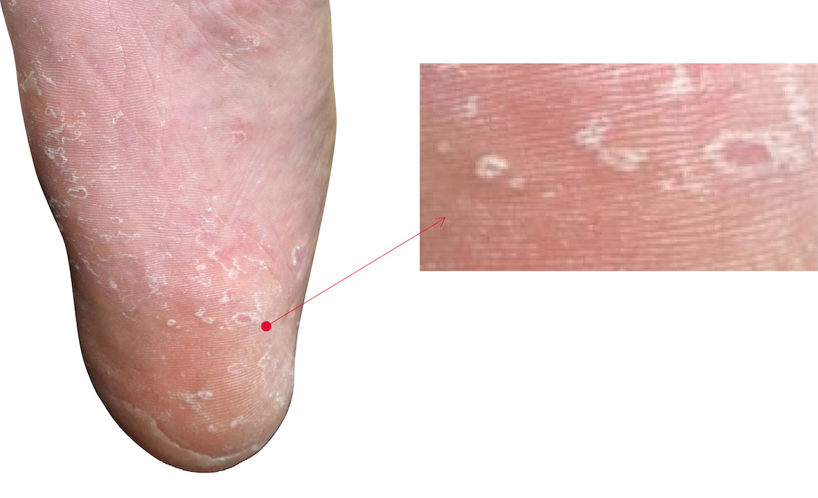 小水泡型香港腳