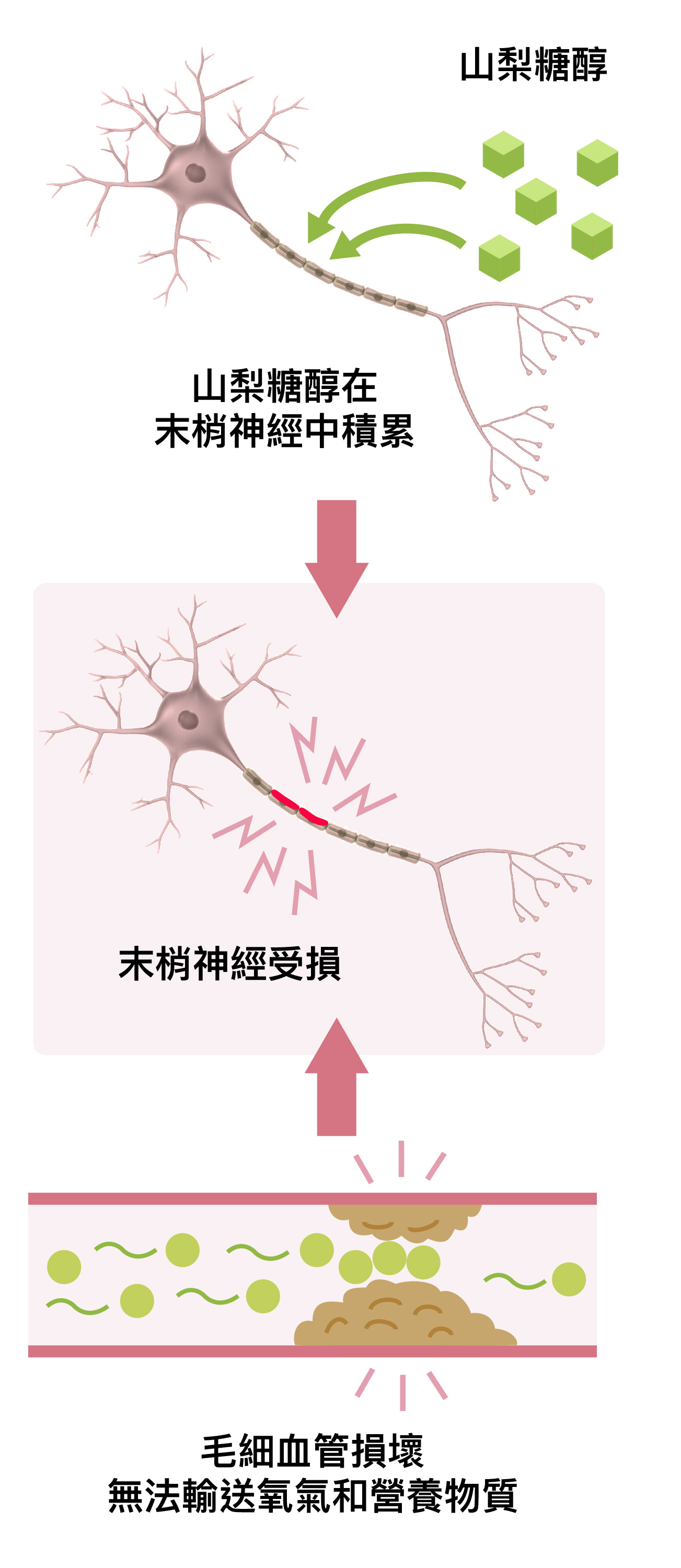 糖尿病神經病變發生原因,末梢神經受損