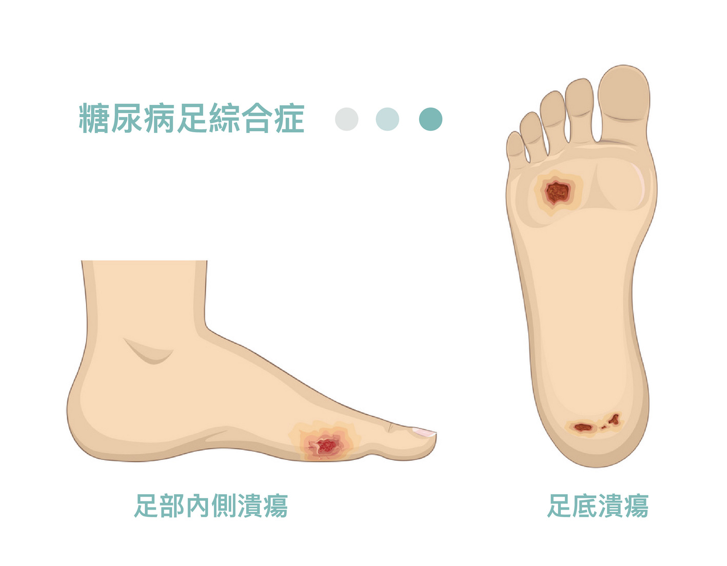 糖尿病足綜合症造成足部內側或足底潰瘍