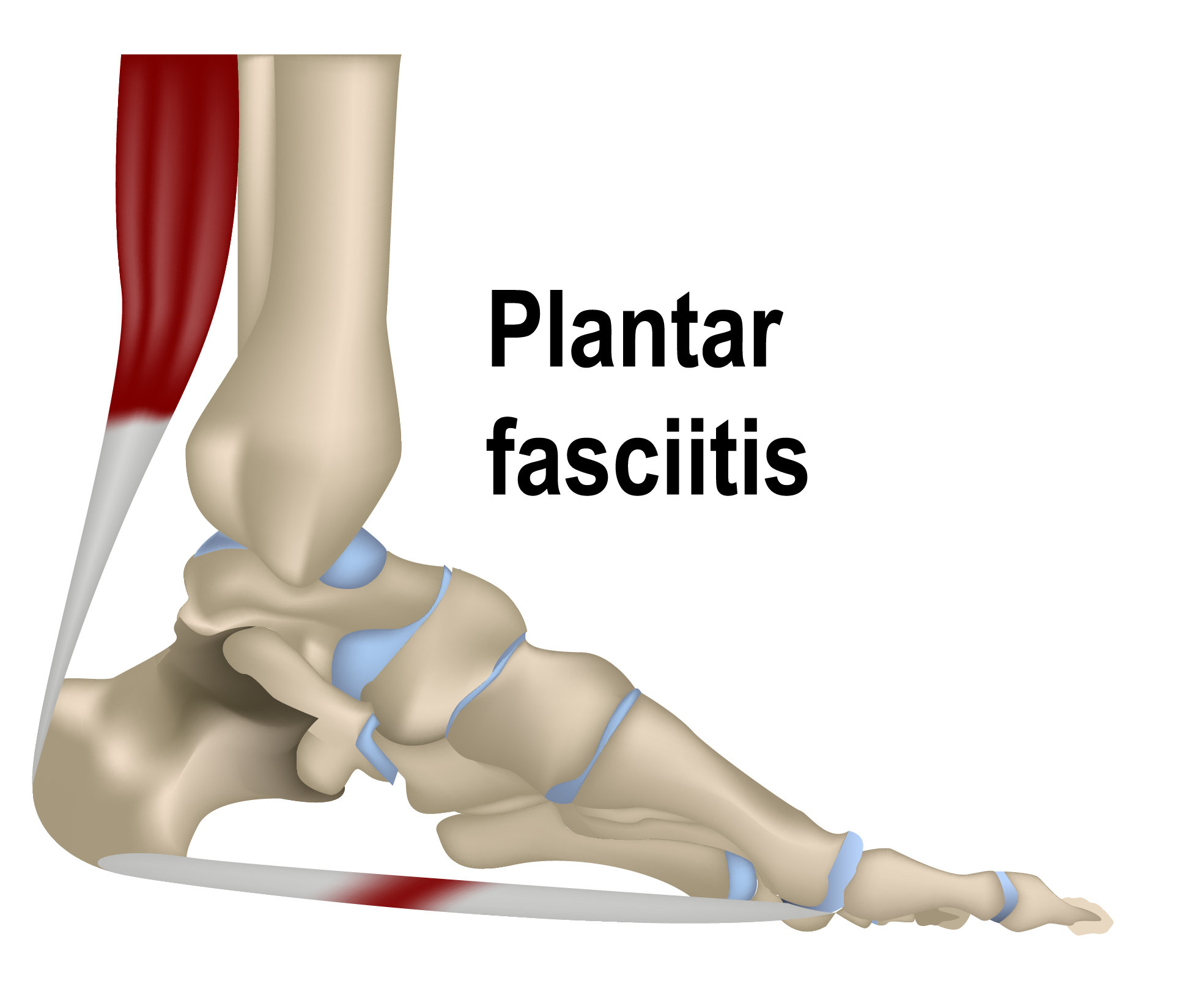 足底筋膜炎結構圖