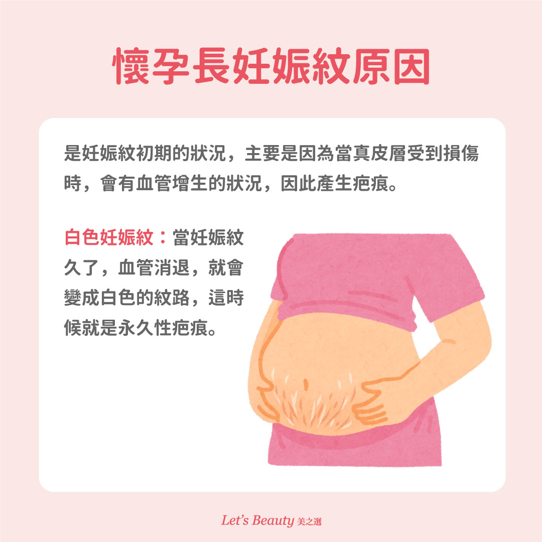 長妊娠紋原因