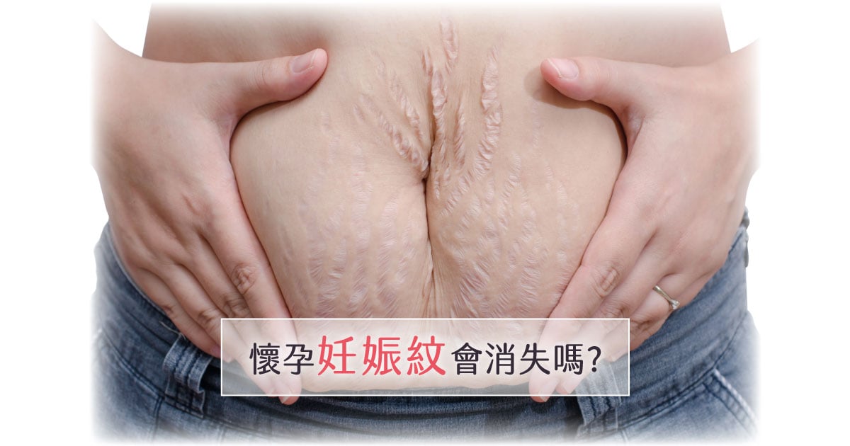 妊娠紋消失、預防的四個方法