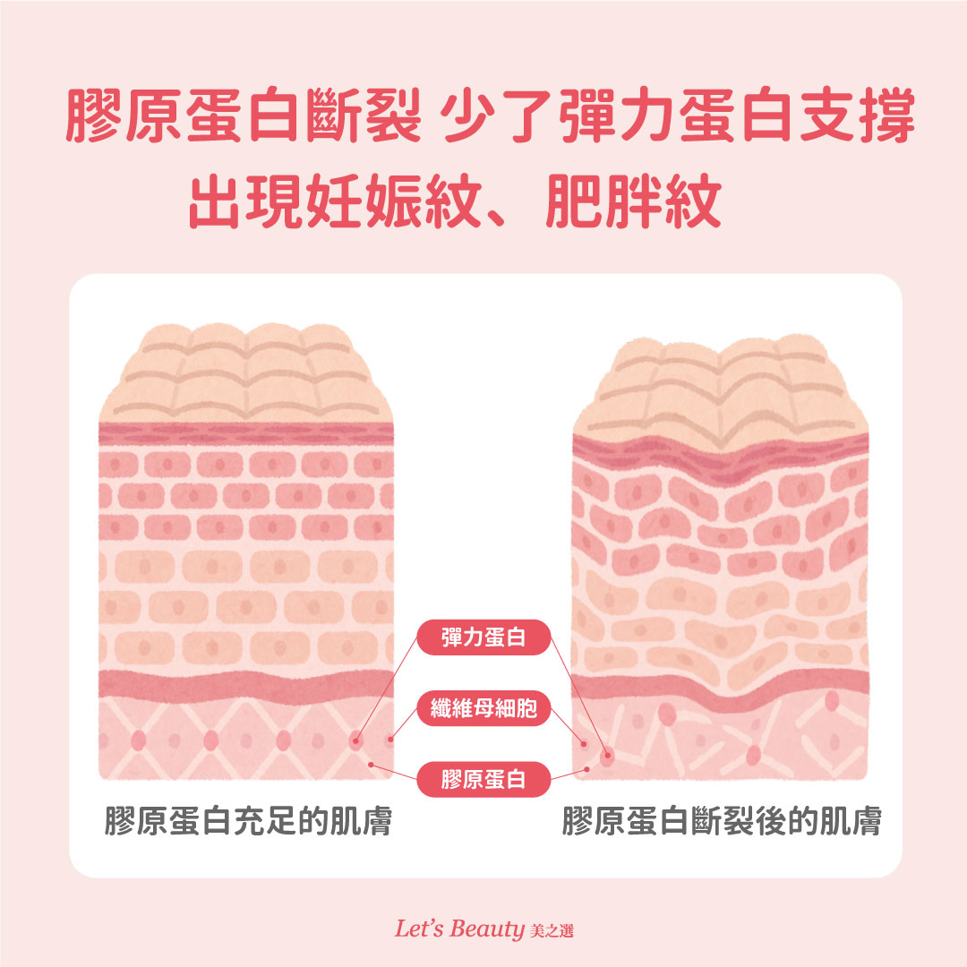 缺少膠原蛋白對肌膚的影響:出現妊娠紋、彈力蛋白斷裂