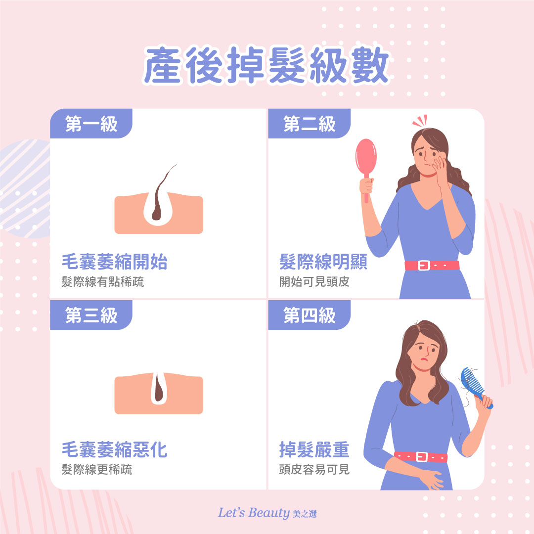產後掉髮級數說明圖解：第一級/毛囊萎縮;第二級/髮際線明顯看到頭皮;第三級/毛囊萎縮惡化髮際線更稀疏;第四級/嚴重掉髮已可看見頭皮
